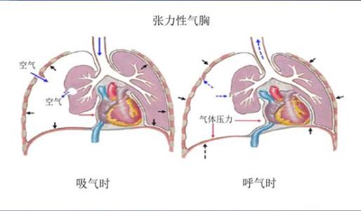 气胸是怎么引起的 气胸是如何形成的