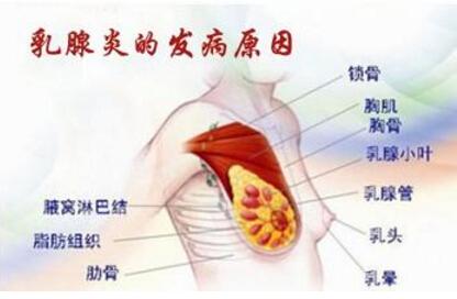 乳腺炎怎么形成的 乳腺炎形成的原因