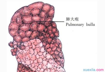 肺大泡形成的原因 肺大泡是怎样形成的 肺大泡的成因是什么