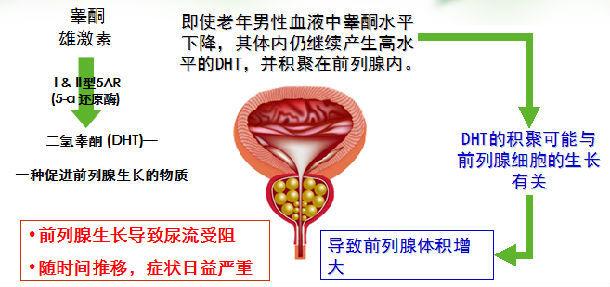 良性前列腺增生自愈 良性前列腺增生的原因