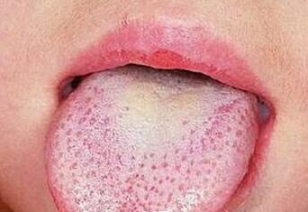 舌头怎么看出肝硬化 舌头怎么看出疾病