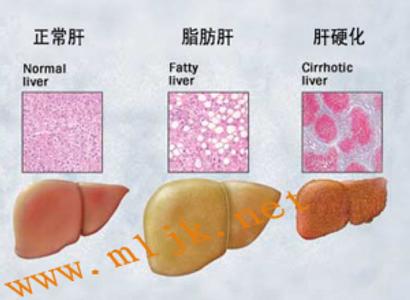 轻度脂肪肝症状有哪些 能改善轻度脂肪肝的食物有哪些
