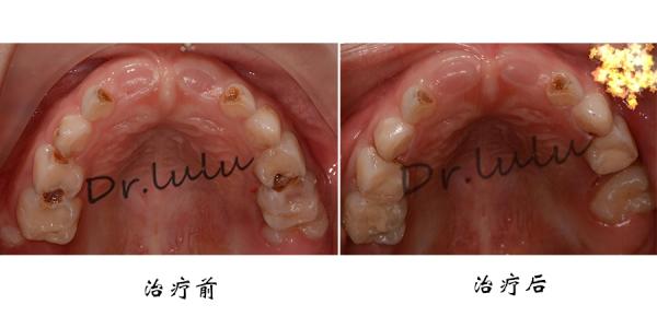 龋齿的治疗方法 龋齿是怎么形成的 龋齿的治疗方法(2)