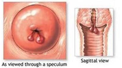宫颈息肉是怎么形成的 孕妇宫颈息肉是怎么形成的