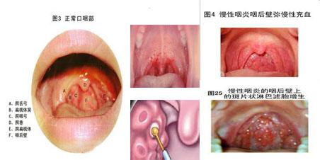 咽炎形成的症状 咽炎是怎样形成的 咽炎有什么症状