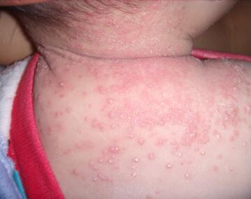 宝宝患干性湿疹的原因 宝宝患湿疹的五大原因