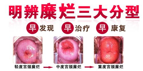 食道糜烂吃什么好得快 宫颈糜烂吃什么好得快 宫颈糜烂用什么药好