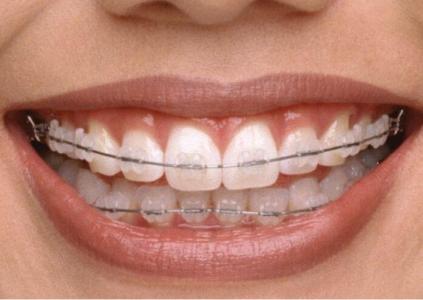 矫正牙齿对脸型的影响 矫正牙齿的危害有哪些