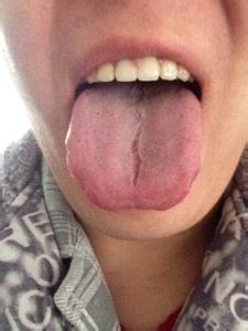 舌头上有裂纹怎么办 舌头上有裂纹怎么回事