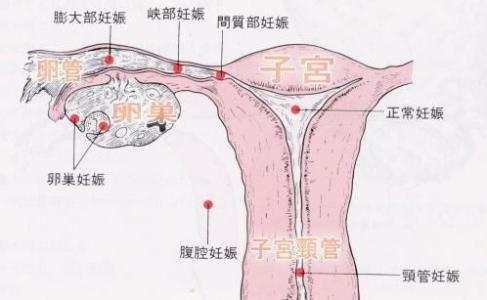 如何预防宫外孕 如何有效预防宫外孕