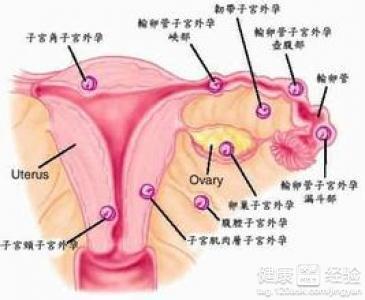 宫外孕多久能发现 宫外孕早期症状