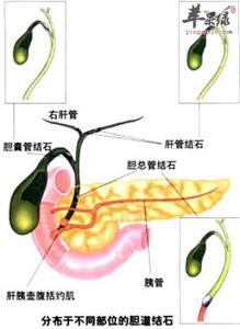 胆囊炎成因 胆囊炎是怎样形成的 胆囊炎的成因和检查