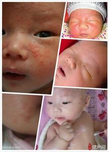 宝宝湿疹最佳治疗方法 秋冬季宝宝长湿疹怎样治疗