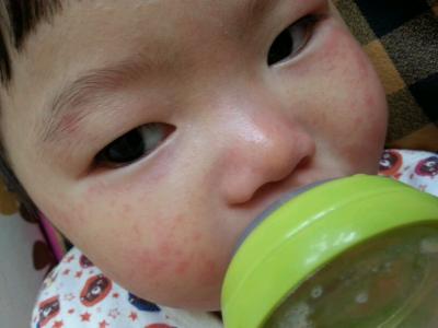 皮肤过敏如何护理 宝宝皮肤过敏的原因 护理错误使宝宝皮肤过敏