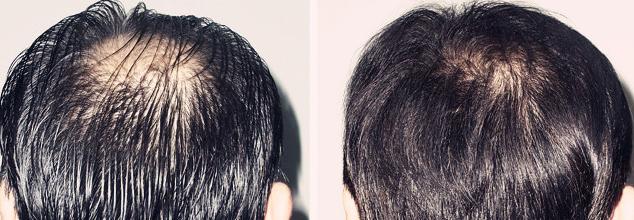 脂溢性脱发的治疗方法 治疗脂溢性脱发的方法介绍