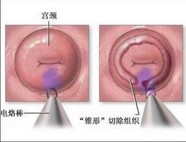 重度宫颈炎有什么症状 宫颈炎的症状 什么是宫颈炎