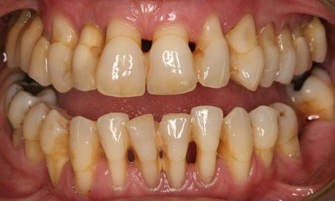 牙周炎吃什么药最有效 牙周炎吃什么药最有效_治疗牙周炎最有效的药