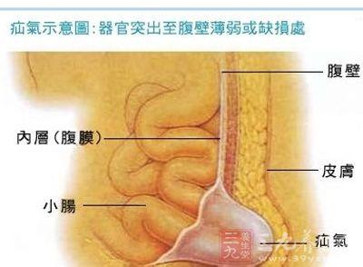 疝气形成的原因 宝宝疝气是怎么形成的原因