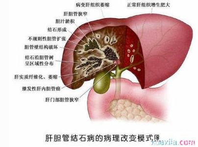 肝结石饮食 肝结石是怎么形成的 肝结石的饮食治疗