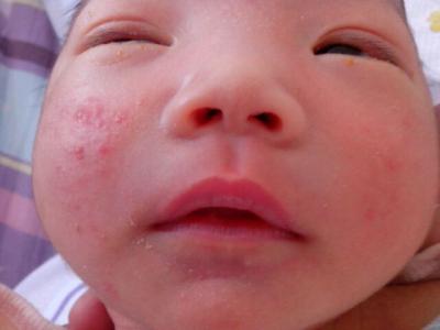 新生儿痤疮和湿疹区别 新生儿痤疮怎么预防 新生儿痤疮和湿疹区别