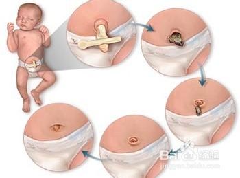 如何护理新生儿脐带 如何护理新生儿的脐带？