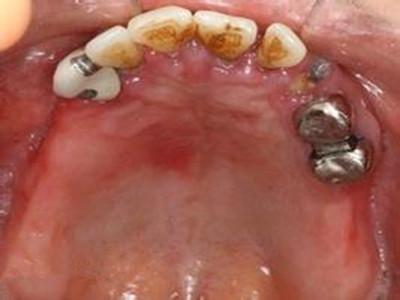 吃什么保护牙龈萎缩 吃什么保护牙龈