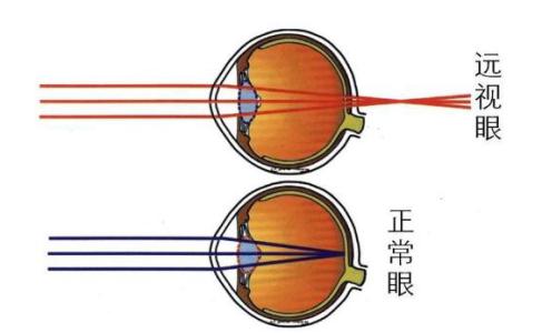 形成远视眼的原因 远视是如何形成的_远视的原因介绍