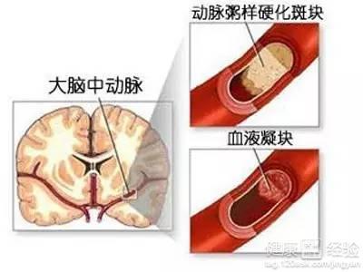 脑梗形成原因 脑梗是什么原因形成的 脑梗有什么症状