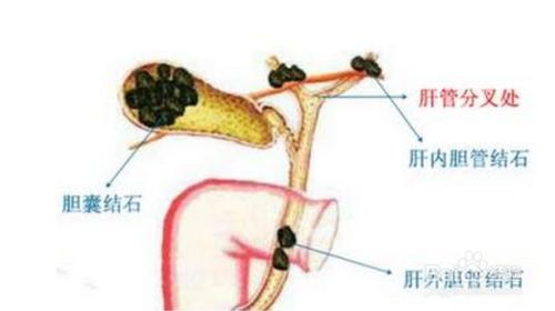 胆固醇结晶怎么治疗 胆固醇结石形成的主要原因