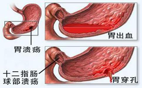 如何预防血栓形成 胃出血是怎么形成的 如何预防