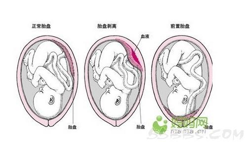 胎盘位置偏低怎么办 低置胎盘该怎么办