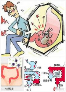 结肠炎怎么诊断 结肠炎怎么形成的 结肠炎的诊断和治疗