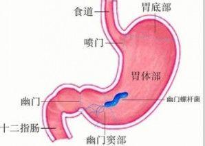 胃癌的早期症状 胃胀是怎么回事