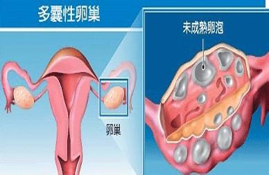 卵巢多囊形成时间 多囊卵巢是怎样形成的