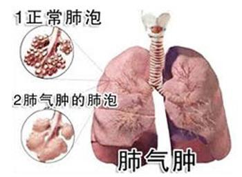 肺气肿能活多久 什么是肺气肿