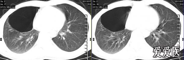 肺大泡形成的原因 肺大泡怎样形成的_肺大泡的原因