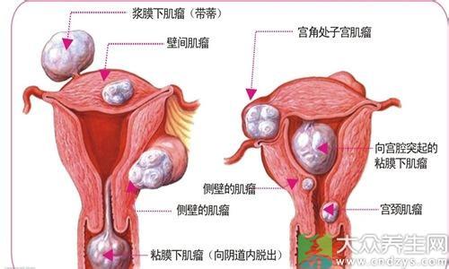 子宫肌瘤怎样引起 子宫肌瘤怎样形成的