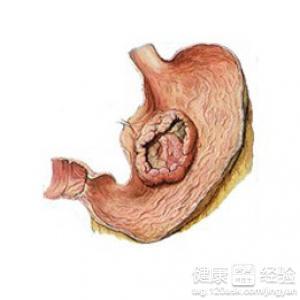 为什么会得胃穿孔 胃穿孔怎么形成的
