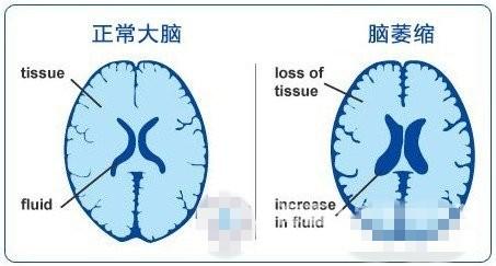 什么原因造成脑萎缩 小脑萎缩形成的原因