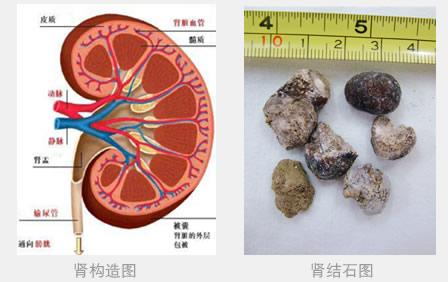 肾结石的形成原因 肾结石是怎么形成的 肾结石的形成原因