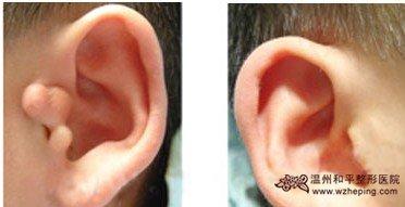 附耳是怎么形成的 附耳是如何形成的