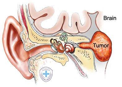 听神经瘤能保守治疗么 听神经瘤形成的原因