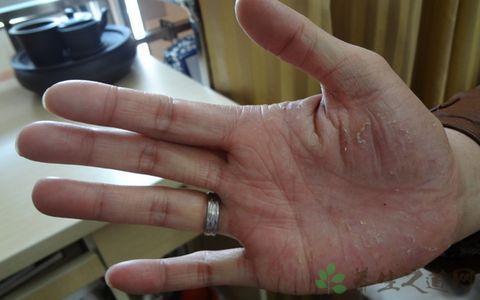 角化型手足藓怎样根治 角化型手足癣治疗