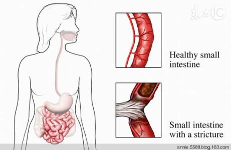 肠道检查有哪些方法 哪些方法能疏通肠道