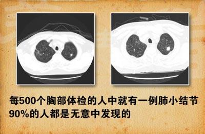 肺部小结节形成原因 肺结节什么原因形成的