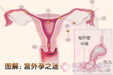 为什么会形成宫外孕 宫外孕是怎么形成的