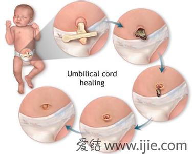宝宝脐带护理 宝宝的脐带要如何护理
