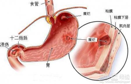 胆汁反流胃炎吃什么菜 胆汁反流性胃炎吃什么