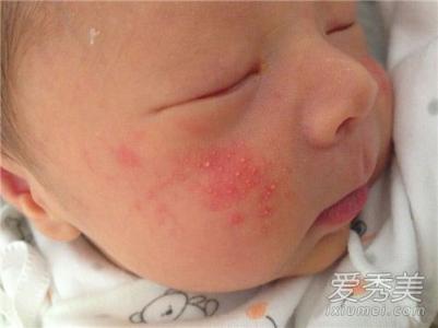 婴儿湿疹是热引起的吗 婴儿湿疹是怎么形成的