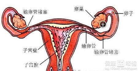 卵巢纤维瘤 卵巢纤维瘤是怎么形成的